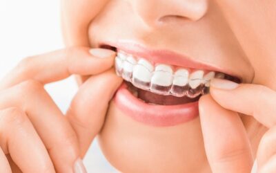 Kalvo-oikomishoito 2025 – Invisalign vs. Clear Aligner